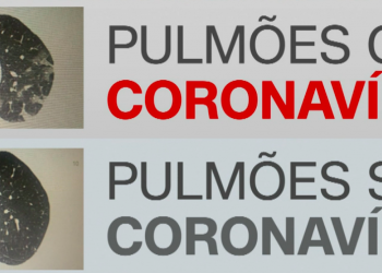 Tomografia revela evolução do coronavírus em pulmões; veja antes e depois