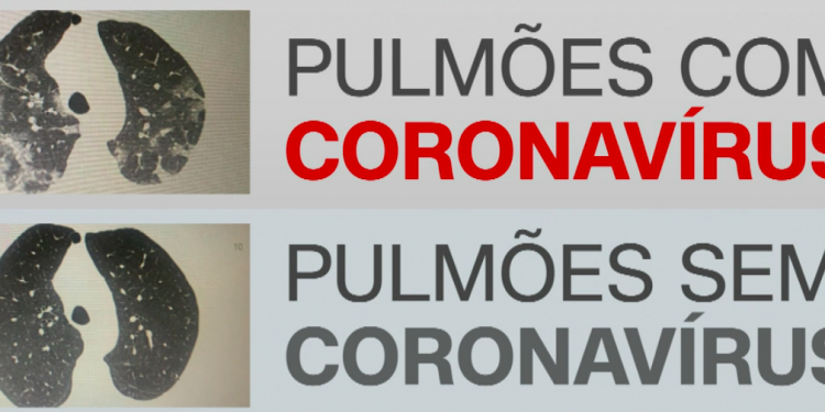 Tomografia revela evolução do coronavírus em pulmões; veja antes e depois 1 Tomografia revela evolução do coronavírus em pulmões; veja antes e depois